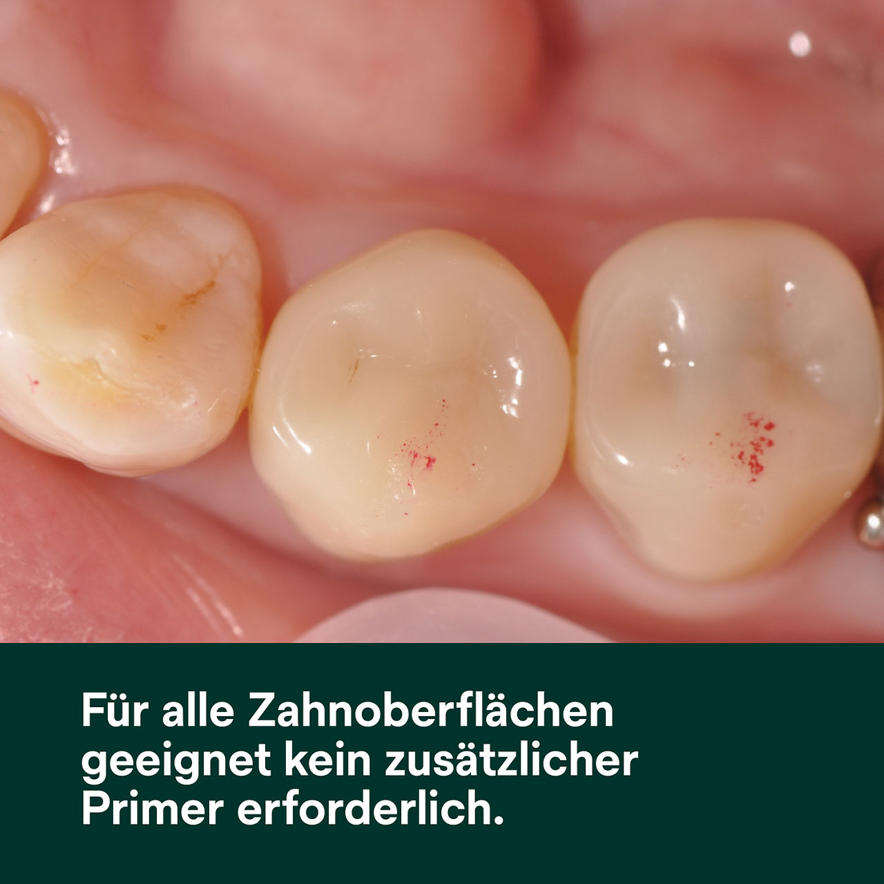 Scotchbond Universal Adhäsiv L-Pop Pa 500